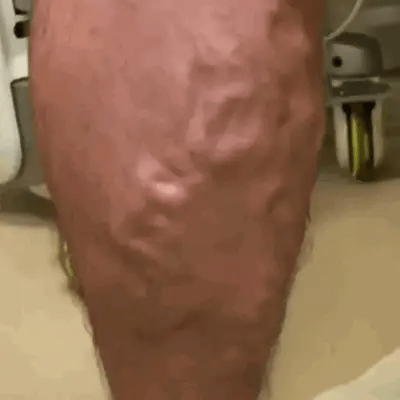Spray para venas en las piernas, mejora la circulación y alivia la hinchazón