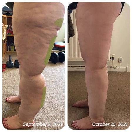 Patch for Reducing Cellulite - Natural Formula