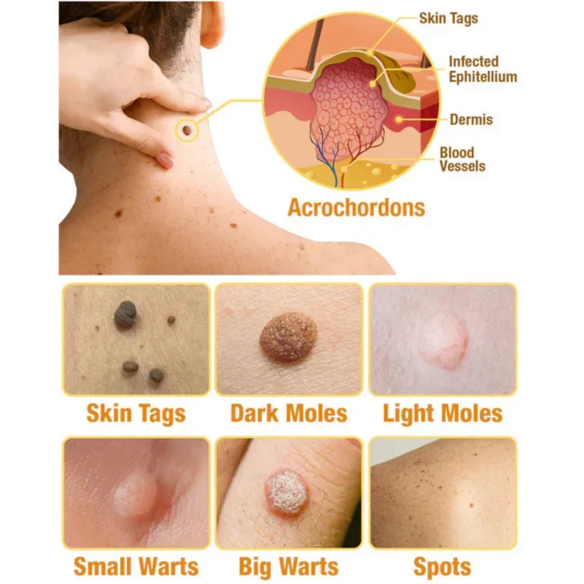 Skin Tag Removal Spray with Natural Bee Venom Extract for At-Home Treatment of Tags, Warts & Moles