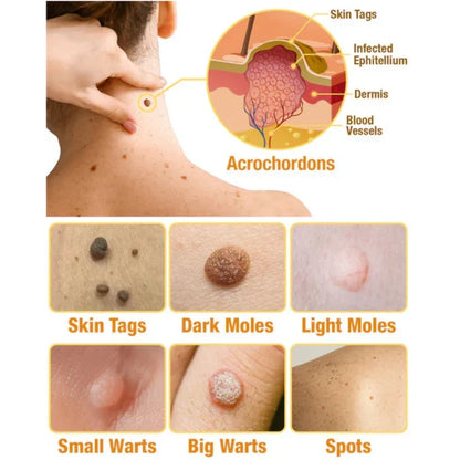 Skin Tag Removal Spray with Natural Bee Venom Extract for At-Home Treatment of Tags, Warts & Moles