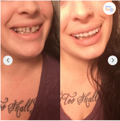 Snap-On Cosmetic Teeth Covers for Upper & Lower Teeth – Instant Smile Veneers for Missing, Broken, or Stained Teeth – Comfortable