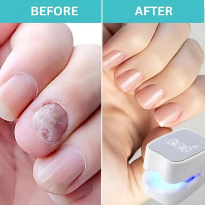 Nail Fungus Treatment 7-Min Daily Antifungal Serum