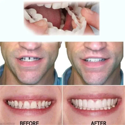 Cosmetic Tooth Veneer Snap-On Cover – Adjustable Fit for Natural-Looking Smile, Removable & Reusable Temporary Smile Enhancement