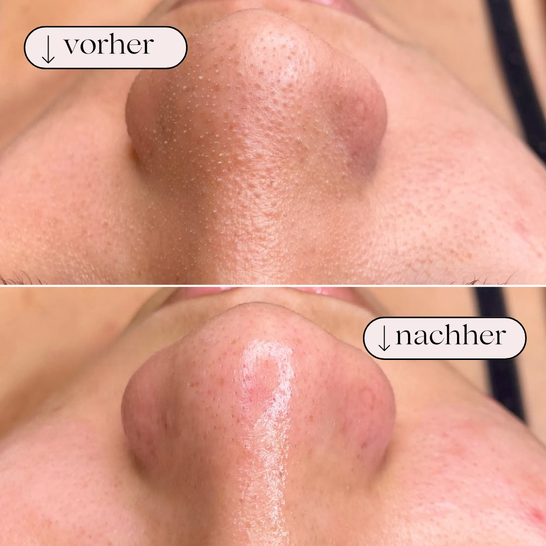 Facial Pore Cleaner with Hydrogen Oxygen Water Jet Technology for Deep Cleansing, Blackhead Removal & Skincare at Home