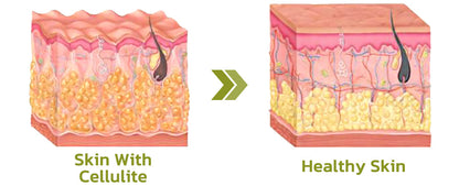 Patch for Reducing Cellulite - Natural Formula