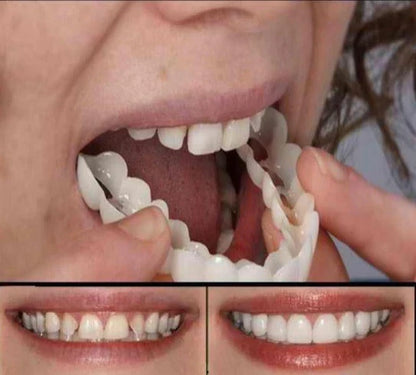 Removable Snap-On Veneers for Temporary Smile Makeover – Heat-Moldable Cosmetic Teeth Covers for Top Teeth