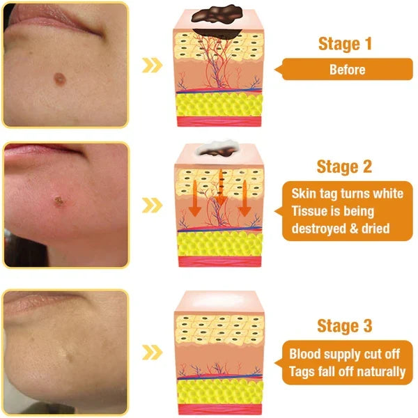 Skin Tag & Wart Removal Spray with Natural Bee Venom Extract for Blemish-Free Complexion at Home Treatment