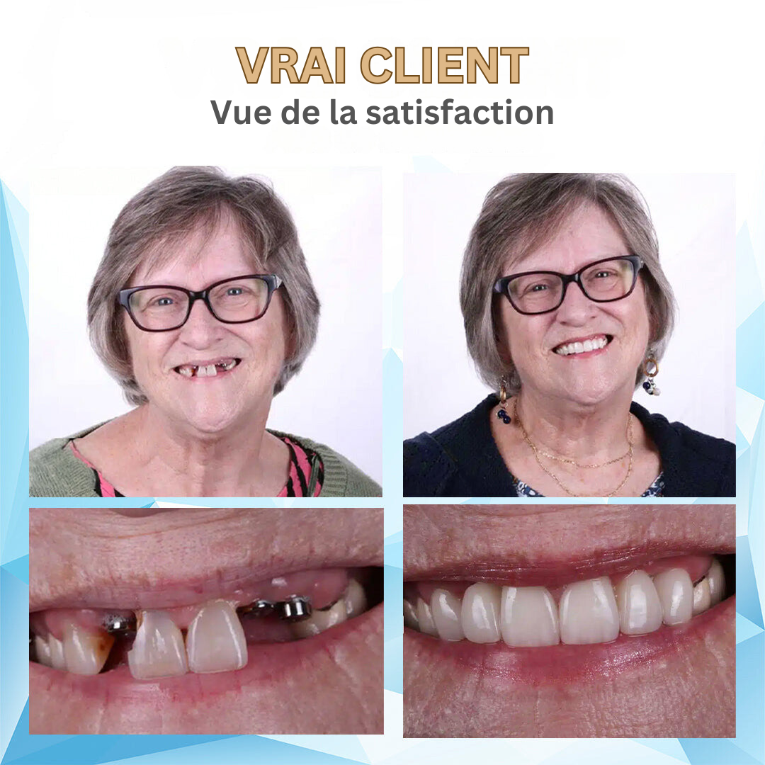 Temporary Cosmetic Teeth Veneers - Moldable Thermal Fit Upper & Lower Denture Smile Kit for Missing Gaps