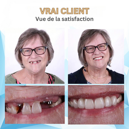 Temporary Cosmetic Teeth Veneers - Moldable Thermal Fit Upper & Lower Denture Smile Kit for Missing Gaps