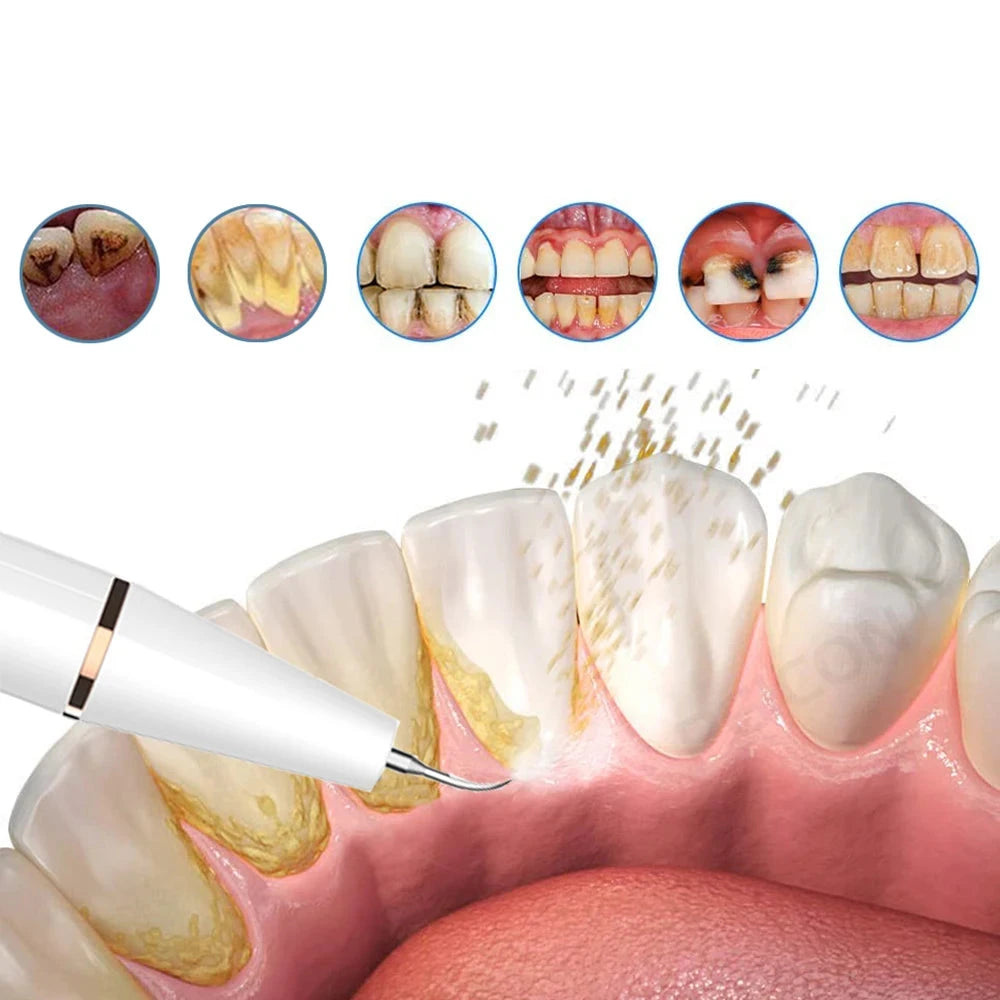 Limpiador dental ultrasónico | Limpiador dental recargable con diseño ergonómico | Eliminador eficaz de manchas dentales para higiene oral en casa