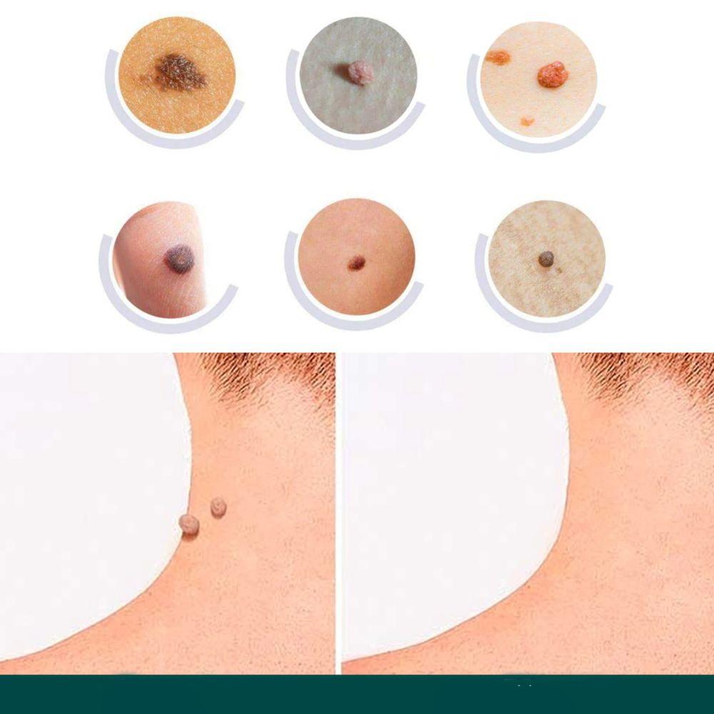 Hydrocolloid Skin Tag & Wart Remover Patches 120-Pack | Gentle Spot Treatment for Home Use | Invisible Adhesive Discs with Tea Tree Oil for