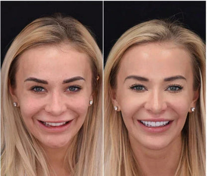 Removable Cosmetic Teeth Covers Set Custom Moldable Dental Veneers for Confidence & Everyday Wear Upper Lower Smile Makeover