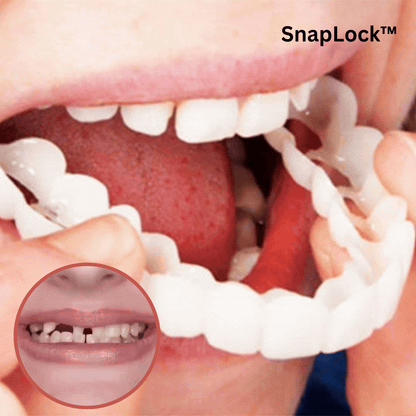 Moldable Snap-On Veneers for Upper & Lower Teeth – Custom-Fit Cosmetic Cover for a Natural White Smile