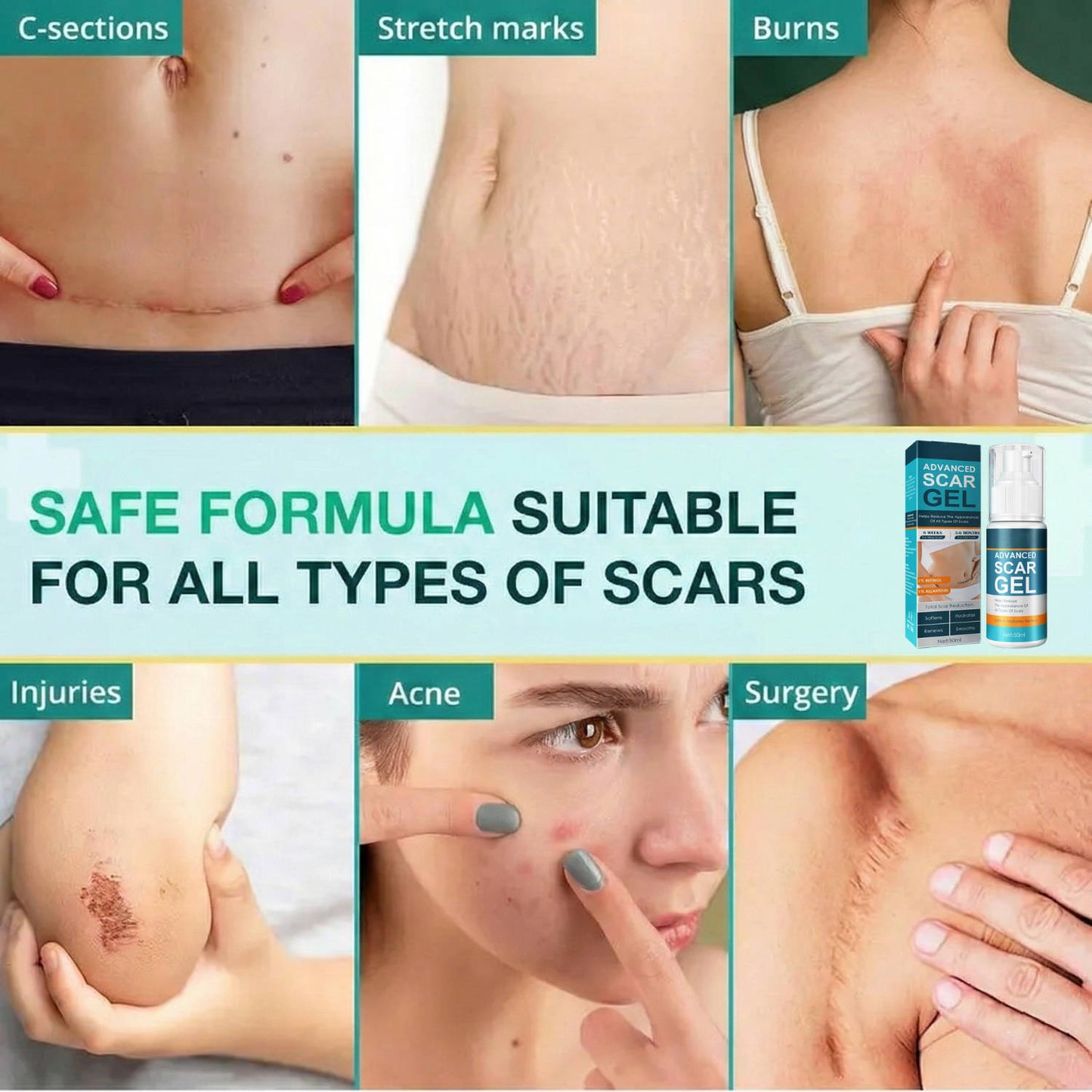 Crema de silicona para eliminar cicatrices y estrías