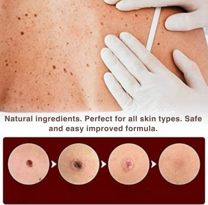Precision Skin Tag & Wart Removal Pen with Botanical Extract Formula for At-Home Spot Treatment