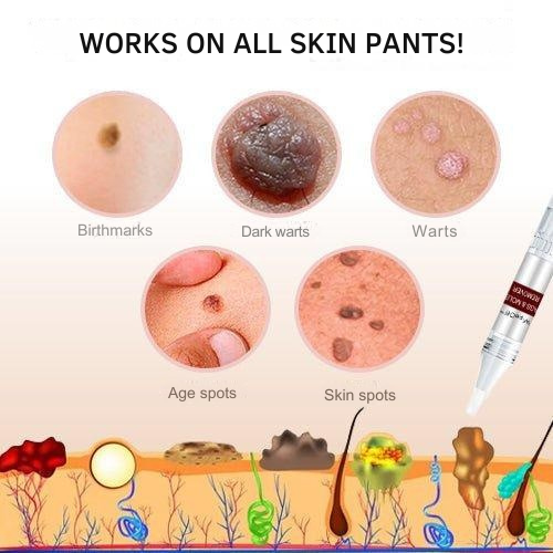 Skin Tag & Wart Removal Pen with Precision Applicator Tip for Spot Treatment at Home | Natural Plant-Based Formula
