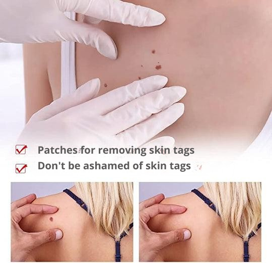 Precision Skin Tag & Wart Removal Pen with Botanical Extract Formula for At-Home Spot Treatment