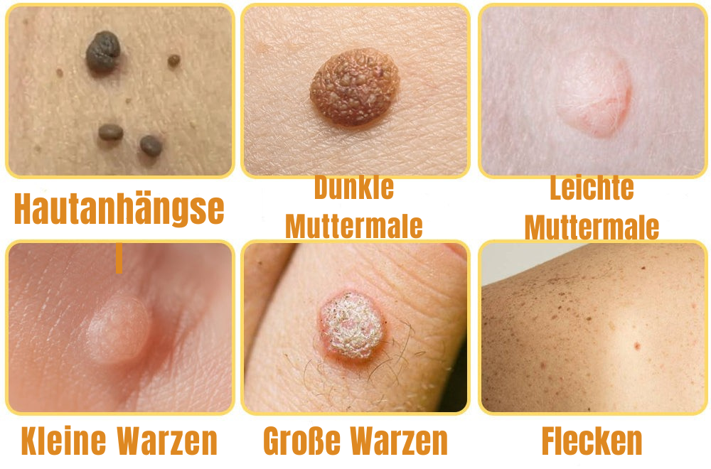 Skin Tag Removal Spray for Warts & Blemishes - Bee Venom Formula - Pain-Free Application - For All Skin Types - Face, Neck, Body Treatment -