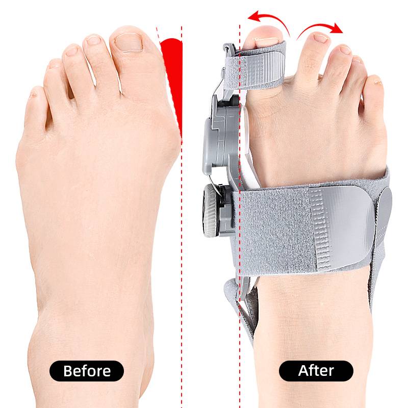 Adjustable Toe Straightener with Hinge System for Hallux Valgus Relief & Foot Alignment – Silicone Spacer for Day & Night Support