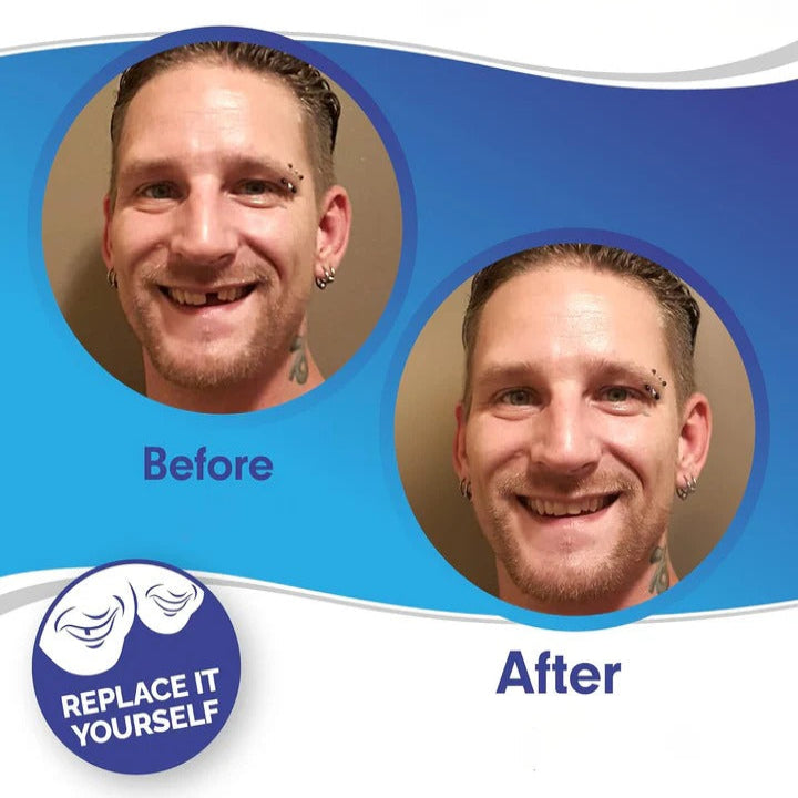 Carillas de Quita y Pon Easy Fit para Dientes Superiores e Inferiores