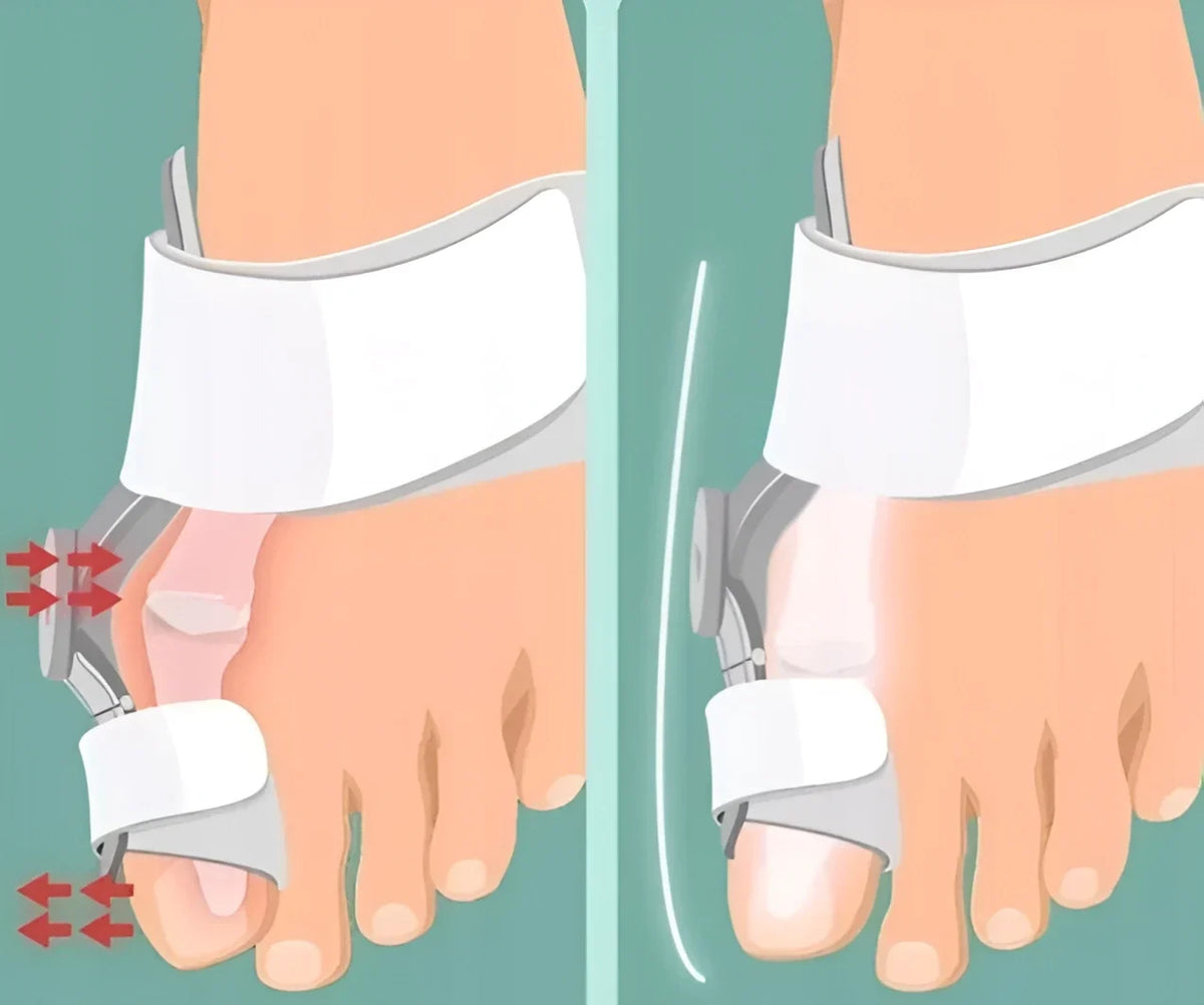 Adjustable Big Toe Splint for Bunion Relief & Alignment | Hinged Night Brace for Pain-Free Walking & Sleep Recovery