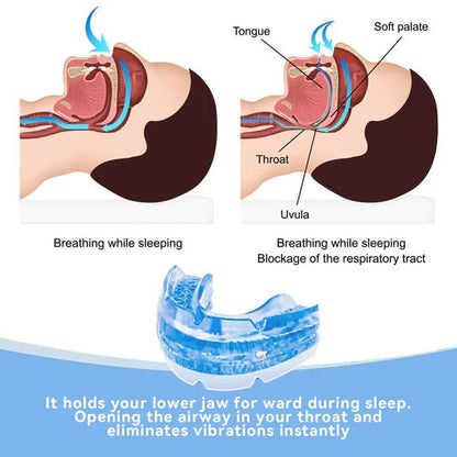 Adjustable Anti-Snoring Mouthpiece for Better Sleep | Custom-Fit Jaw Alignment Guard | BPA-Free Heat-Moldable Design for Nighttime Use | Reu