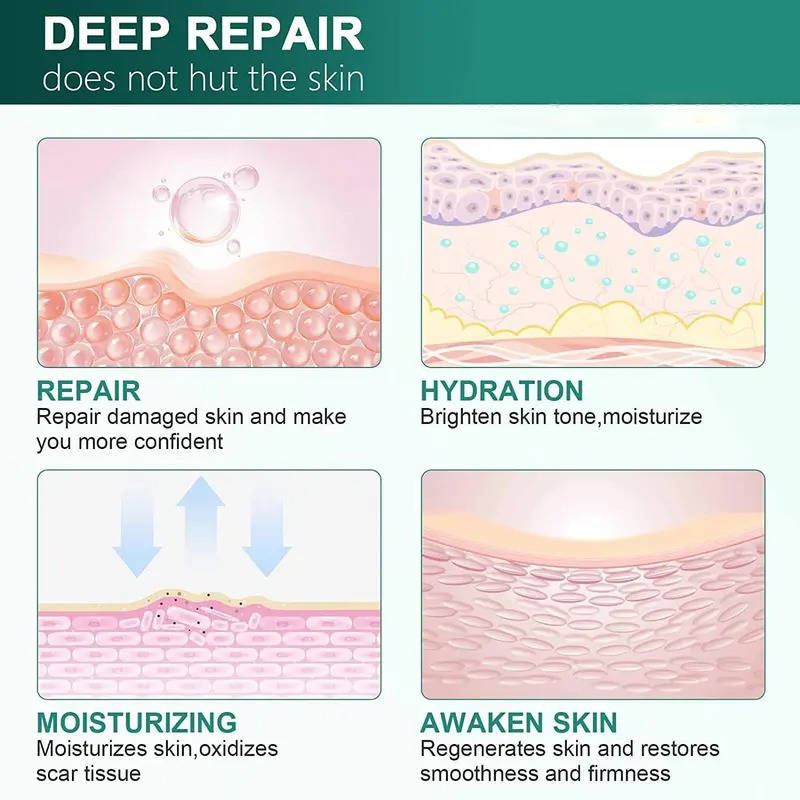 Crema de silicona para eliminar cicatrices y estrías