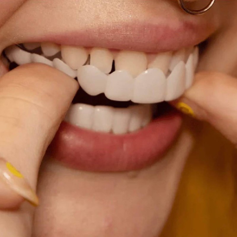 Kit de carillas dentales fácil para una sonrisa perfecta