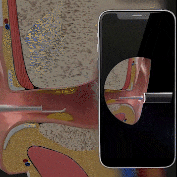Visual Ear Wax Removal Tool with HD Camera Scope for iPhone Android Wireless Ear Cleaning Kit Safe Scoop Adults Kids